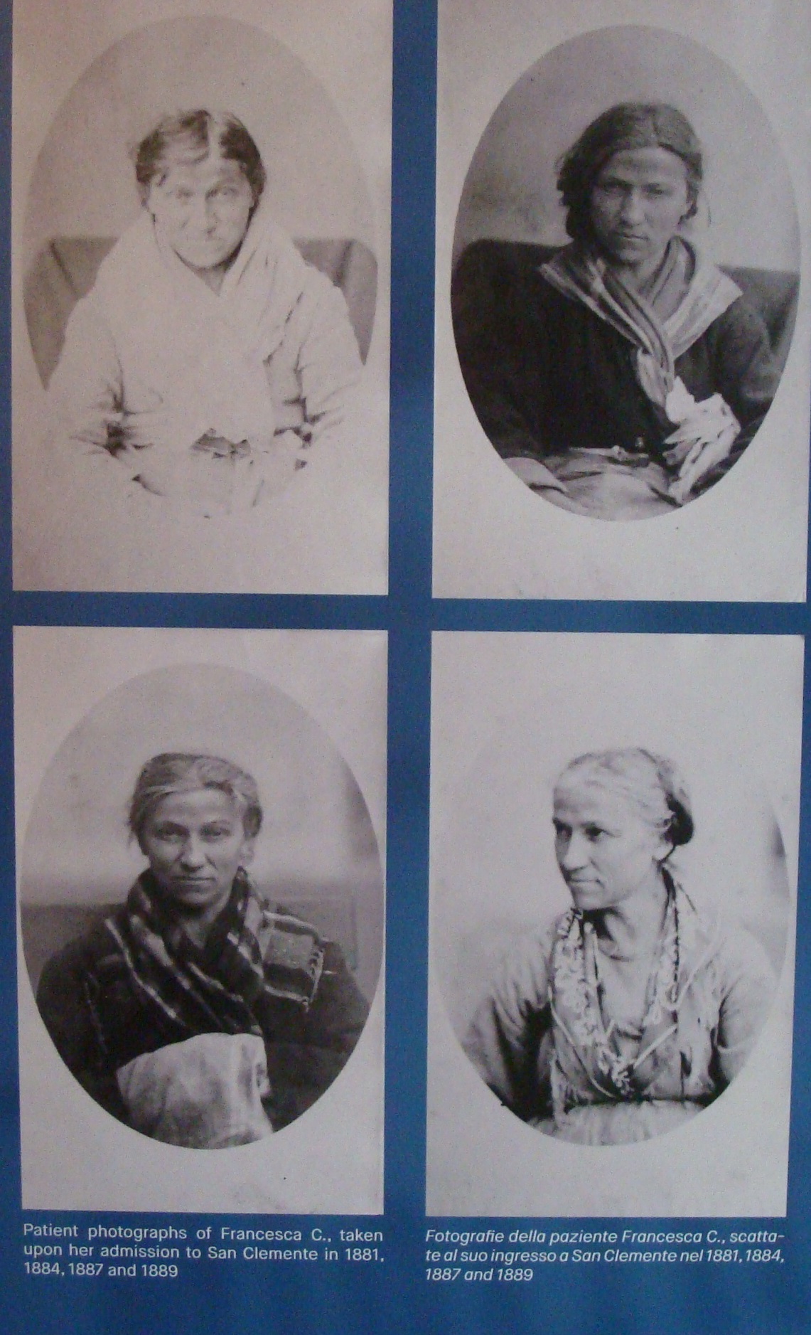 PELLAGRA: Mais, Pellagra e Pazzia nel Veneto 1850 – 1900 - ROUGH SKIN: Maize, Pellagra and Insanity in the Veneto Italy 1850 - 1900